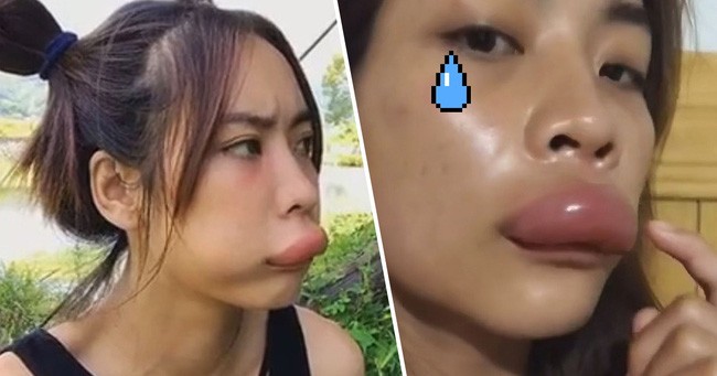 Mơ thấy cô em xấu xí bị ong đốt 